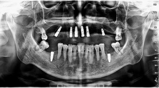 Çene Cerrahisi ve İmplantoloji Uzm. Dr. Erman Şenel Modern Diş Polikliniği